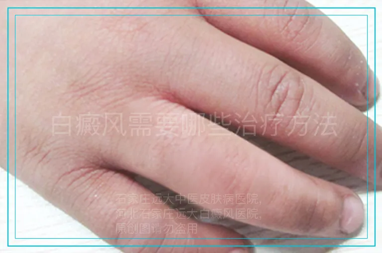 白癜风需要哪些治疗方法