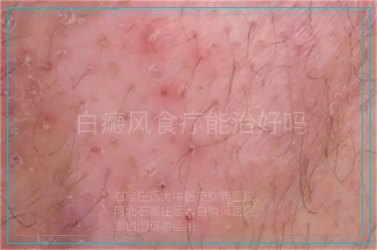 白癜风食疗能治好吗
