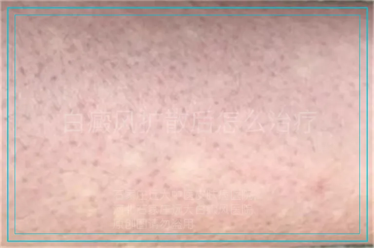 白癜风扩散后怎么治疗