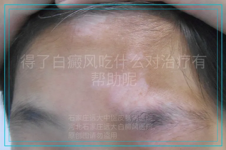 得了白癜风吃什么对治疗有帮助呢