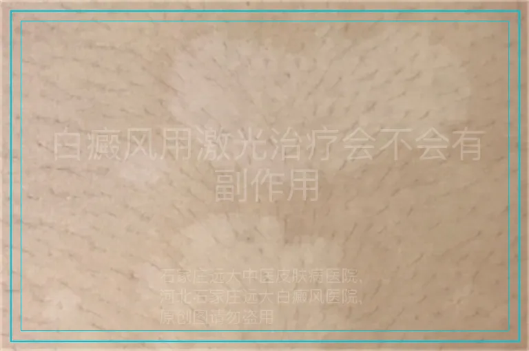 白癜风用激光治疗会不会有副作用