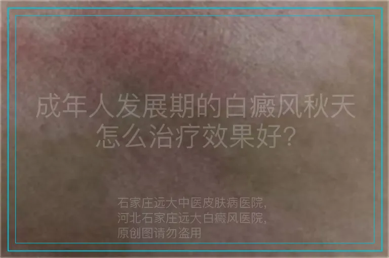 成年人发展期的白癜风秋天怎么治疗效果好?
