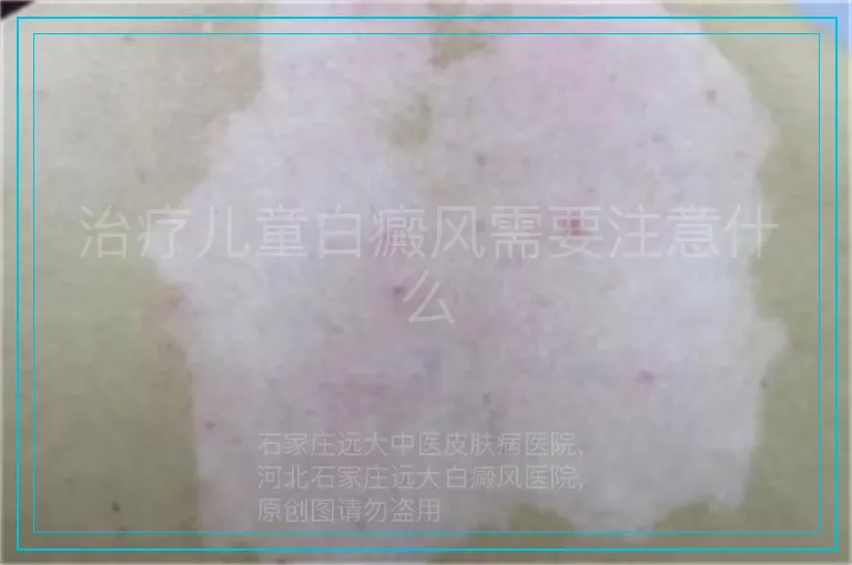 治疗儿童白癜风需要注意什么