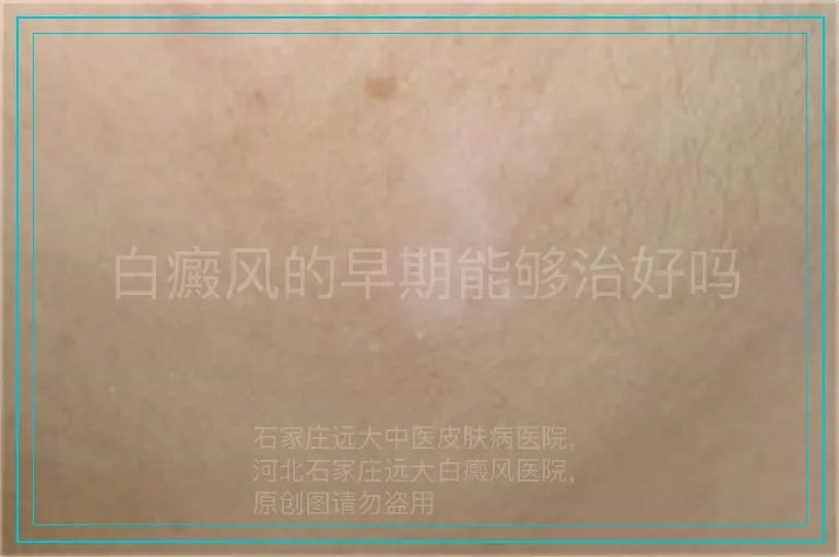 白癜风的早期能够治好吗