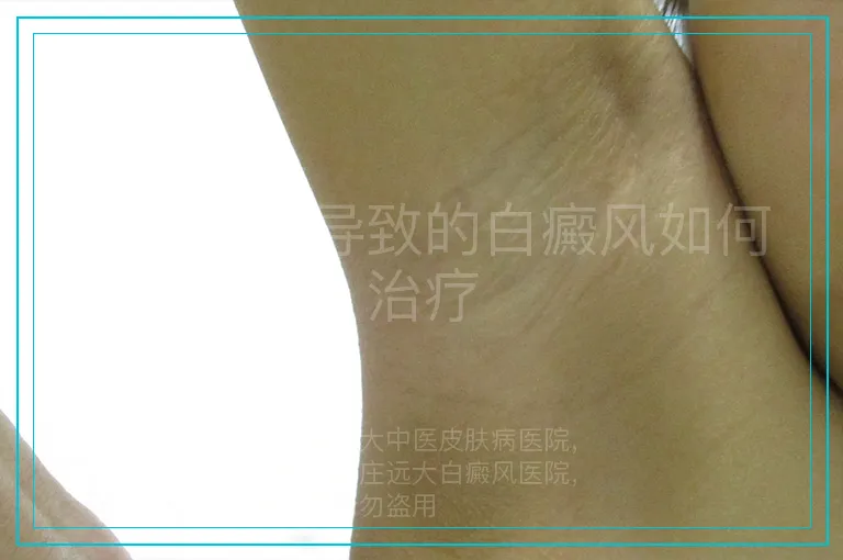 气血不足导致的白癜风如何治疗