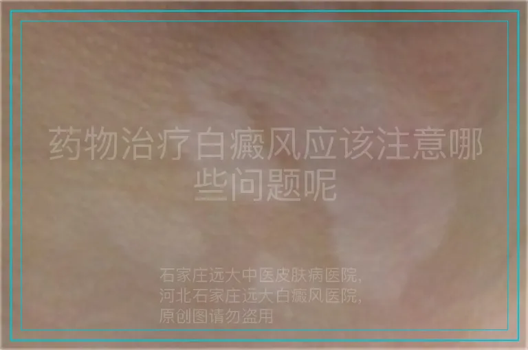 药物治疗白癜风应该注意哪些问题呢