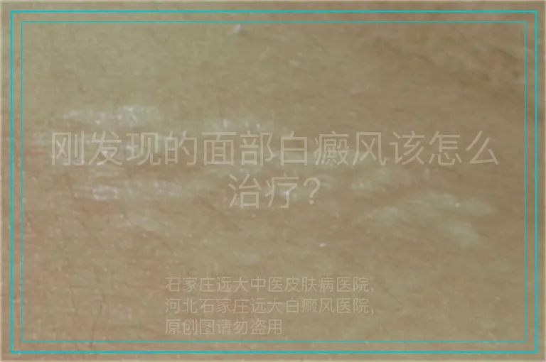 刚发现的面部白癜风该怎么治疗?