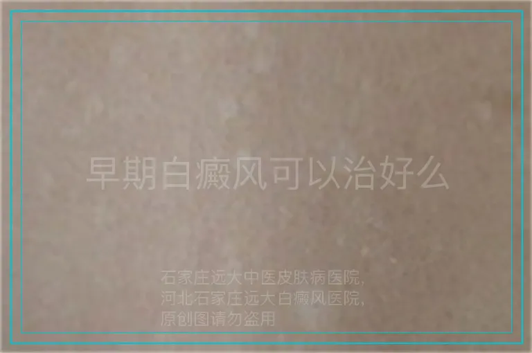 早期白癜风可以治好么