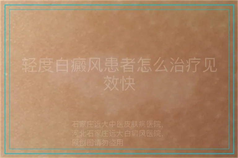 轻度白癜风患者怎么治疗见效快