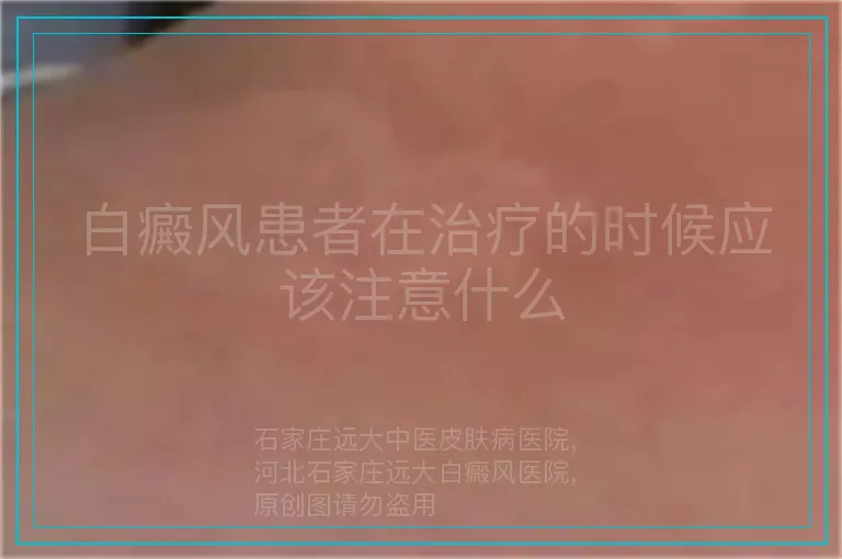 白癜风患者在治疗的时候应该注意什么