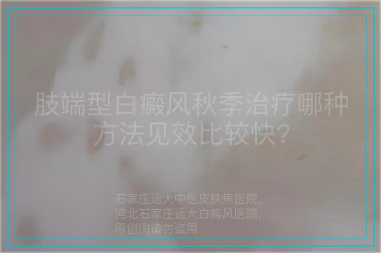 肢端型白癜风秋季治疗哪种方法见效比较快?
