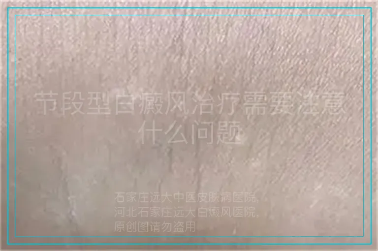 节段型白癜风治疗需要注意什么问题