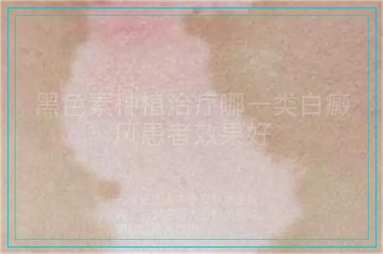 黑色素种植治疗哪一类白癜风患者效果好