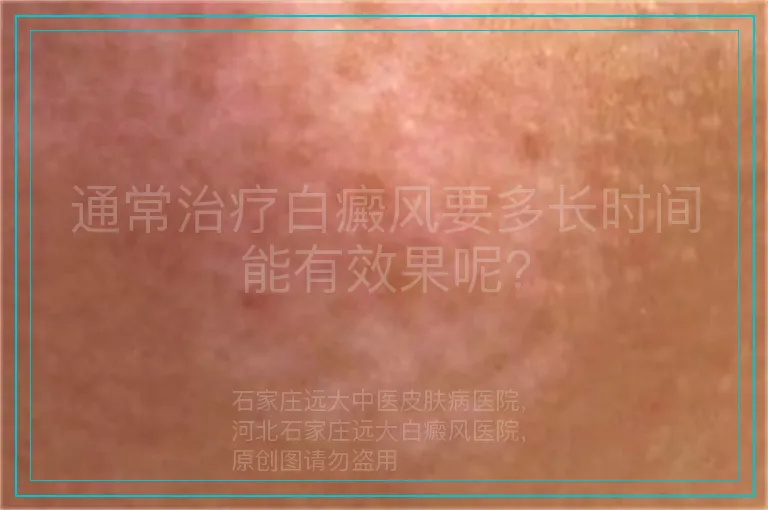 通常治疗白癜风要多长时间能有效果呢?