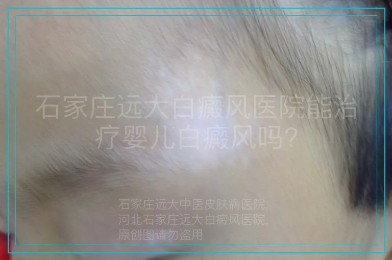 石家庄远大白癜风医院能治疗婴儿白癜风吗?