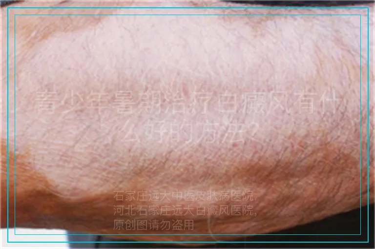 青少年暑期治疗白癜风有什么好的方法?