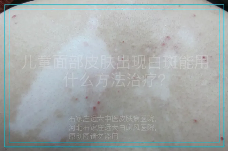 儿童面部皮肤出现白斑能用什么方法治疗?