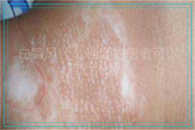 白癜风什么程度的患者可以进行治疗?