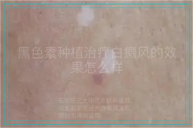 黑色素种植治疗白癜风的效果怎么样