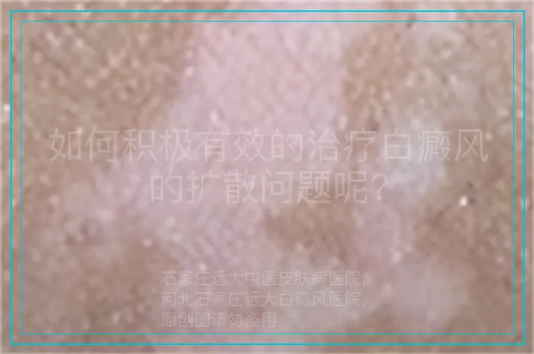 如何积极有效的治疗白癜风的扩散问题呢?