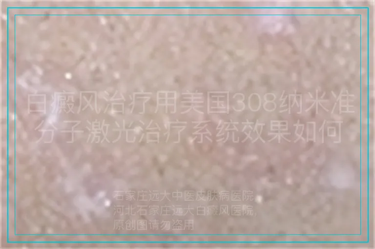 白癜风治疗用美国308纳米准分子激光治疗系统效果如何