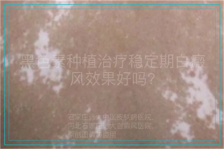 黑色素种植治疗稳定期白癜风效果好吗?
