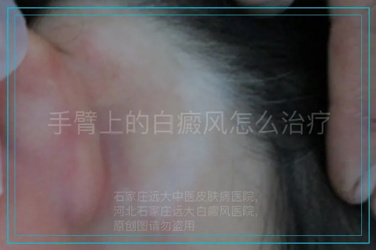 手臂上的白癜风怎么治疗