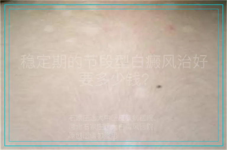 稳定期的节段型白癜风治好要多少钱?