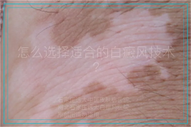 怎么选择适合的白癜风技术?
