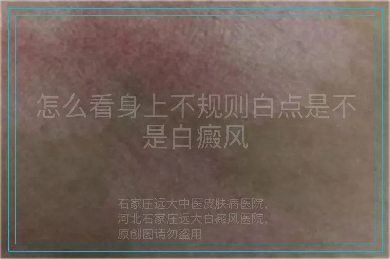 怎么看身上不规则白点是不是白癜风