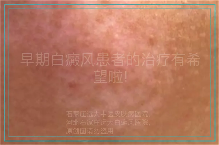 早期白癜风患者的治疗有希望啦!