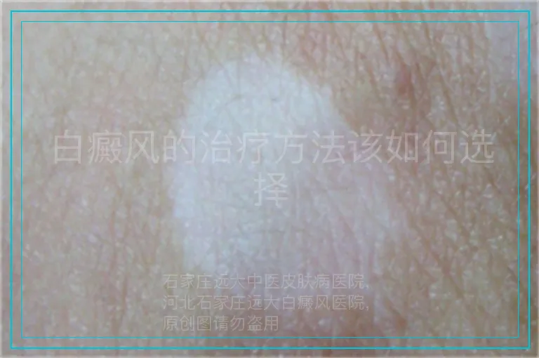 白癜风的治疗方法该如何选择