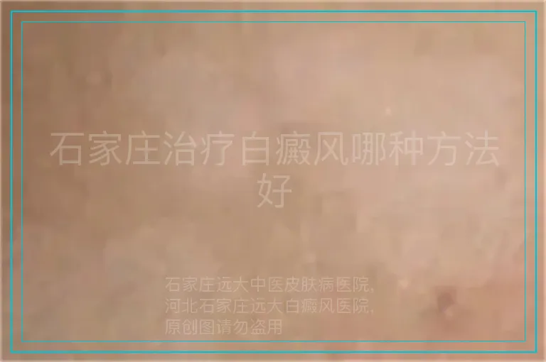 石家庄治疗白癜风哪种方法好