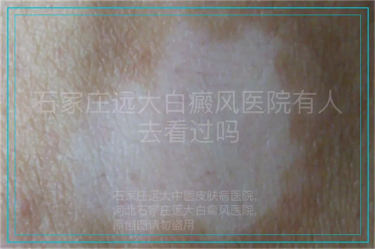 石家庄远大白癜风医院有人去看过吗
