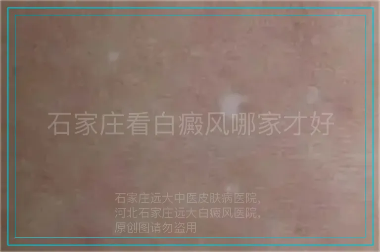 石家庄看白癜风哪家才好