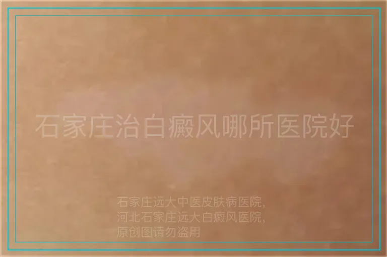 石家庄治白癜风哪所医院好