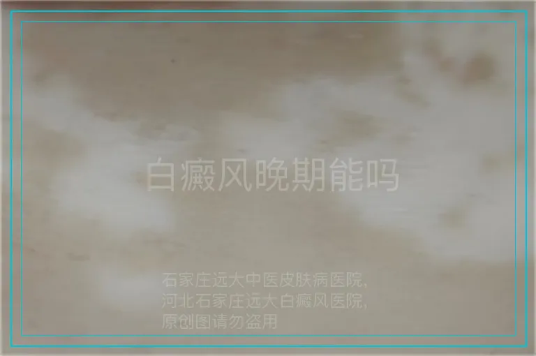 白癜风晚期能吗