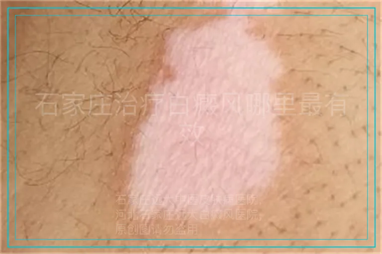 石家庄治疗白癜风哪里最有效