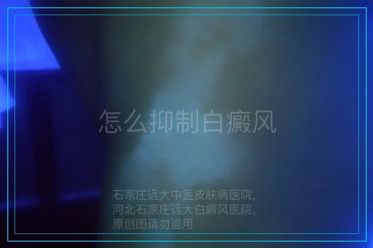 怎么抑制白癜风