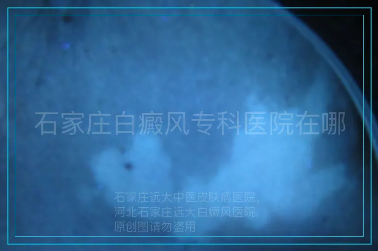 石家庄白癜风专科医院在哪