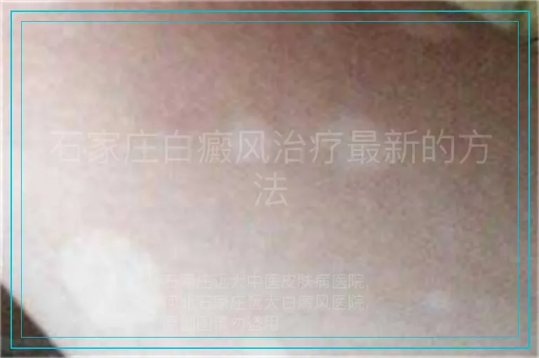 石家庄白癜风治疗最新的方法