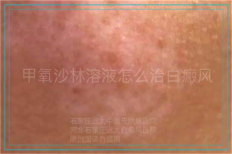 甲氧沙林溶液怎么治白癜风
