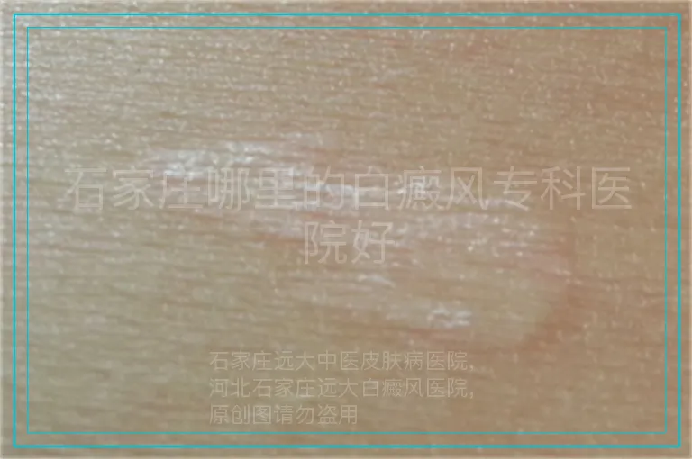 石家庄哪里的白癜风专科医院好