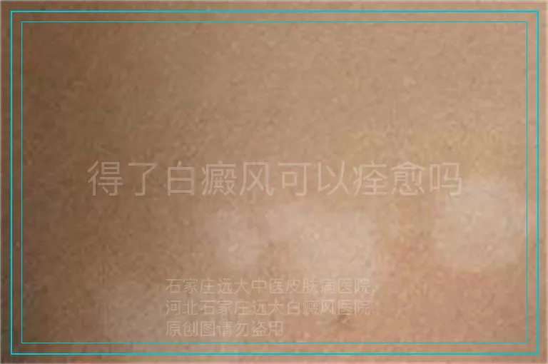 得了白癜风可以痊愈吗