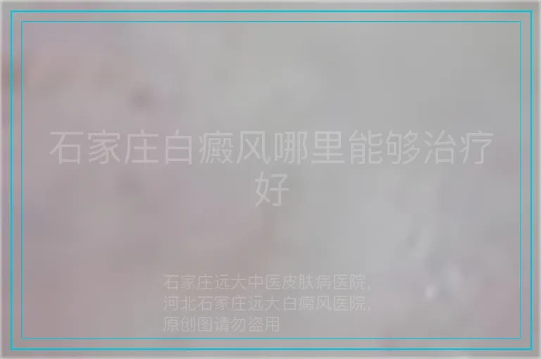 石家庄白癜风哪里能够治疗好