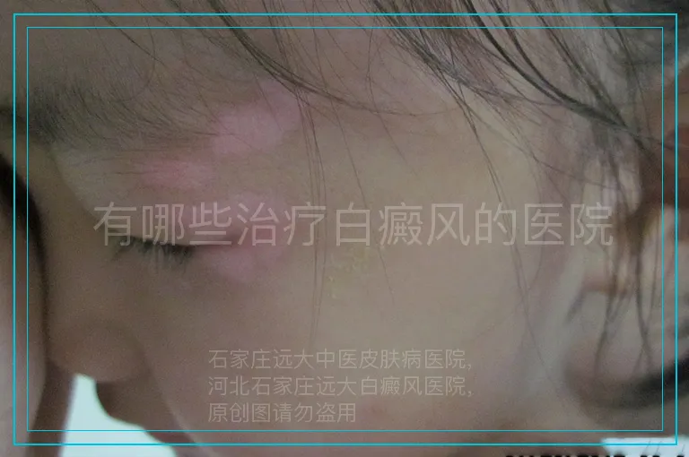 有哪些治疗白癜风的医院