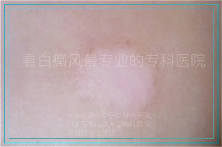 看白癜风最专业的专科医院