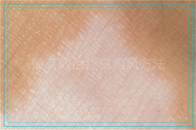 最有效治疗白癜风方法