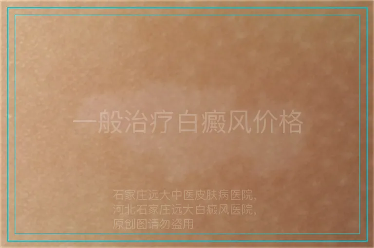 一般治疗白癜风价格