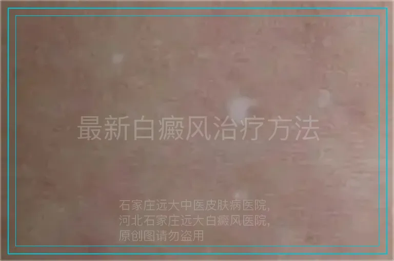 最新白癜风治疗方法